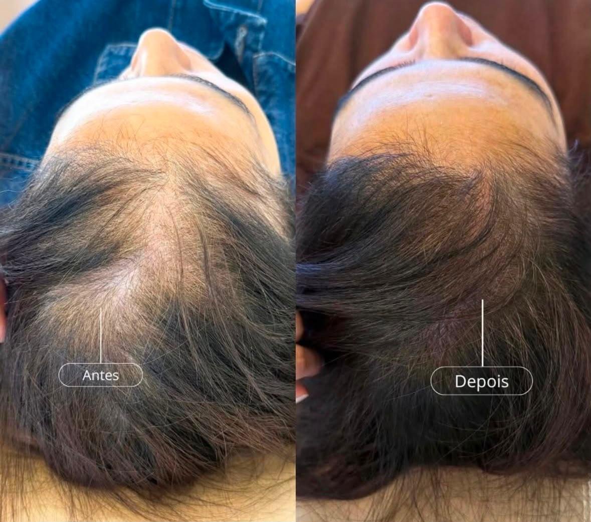 Resultado antes e depois do tratamento capilar com exossomos na AMMO