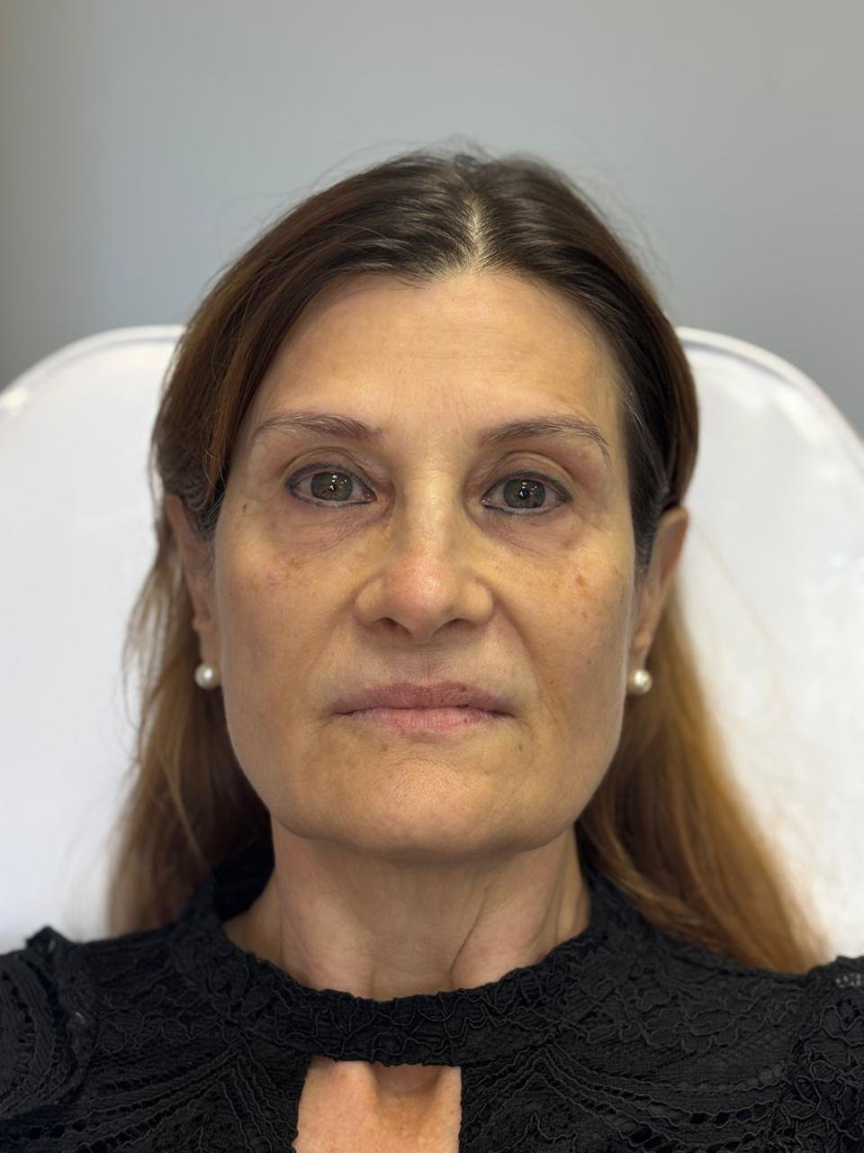 Antes do preenchimento labial e harmonização facial na AMMO