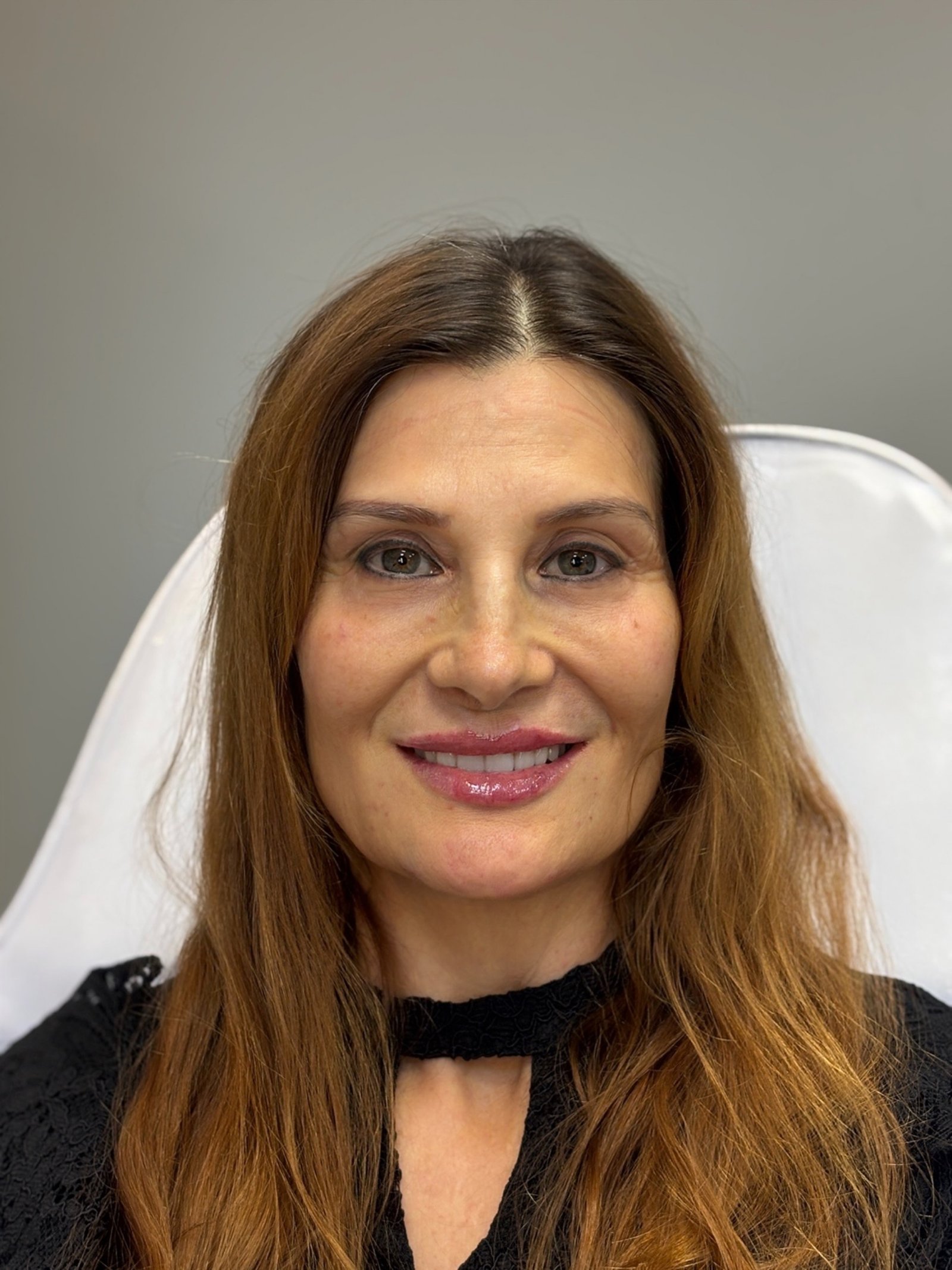 Depois do preenchimento labial e harmonização facial na AMMO